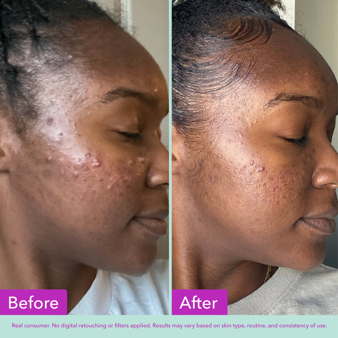 acne-foaming-cleanser-v3 zb_p.jpg
