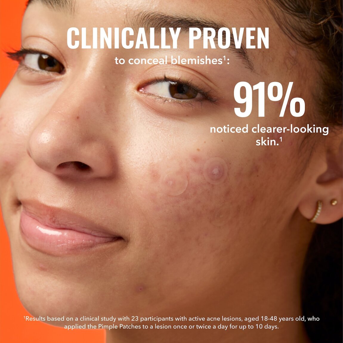 pimple-patches-w1 zb_p.jpg